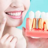 Implantes dentales en Alicante, tecnología CAD-CAM en Alicante.